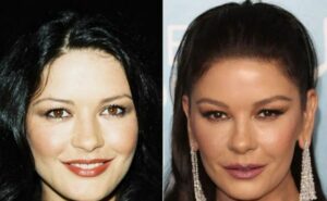 Doctors Talk About Catherine Zeta-Jones' Plastic Surgery Claims